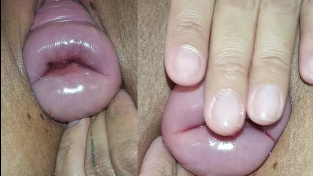 MayaSimons - Prolapsed Cervix Closeup 00010 MayaSimons - Prolapsed Cervix Closeup 00010